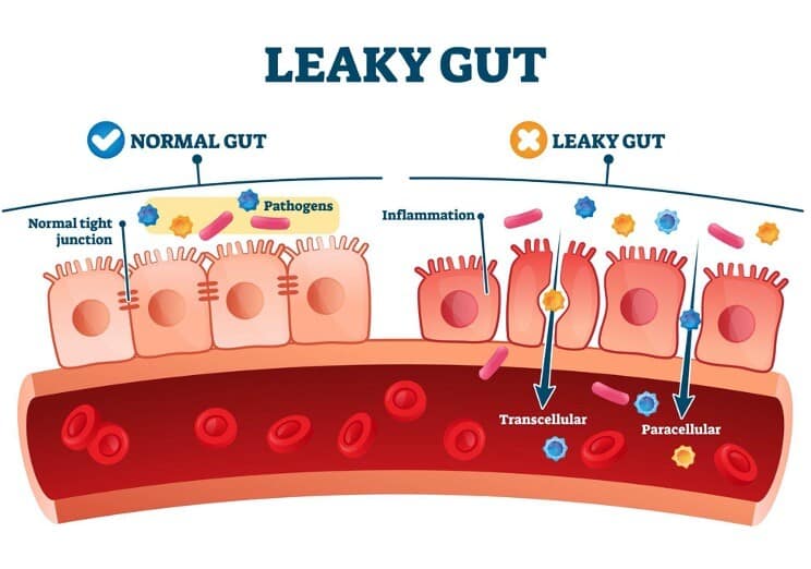 8 Signs You May Have a Leaky Gut (and How to Fix It)