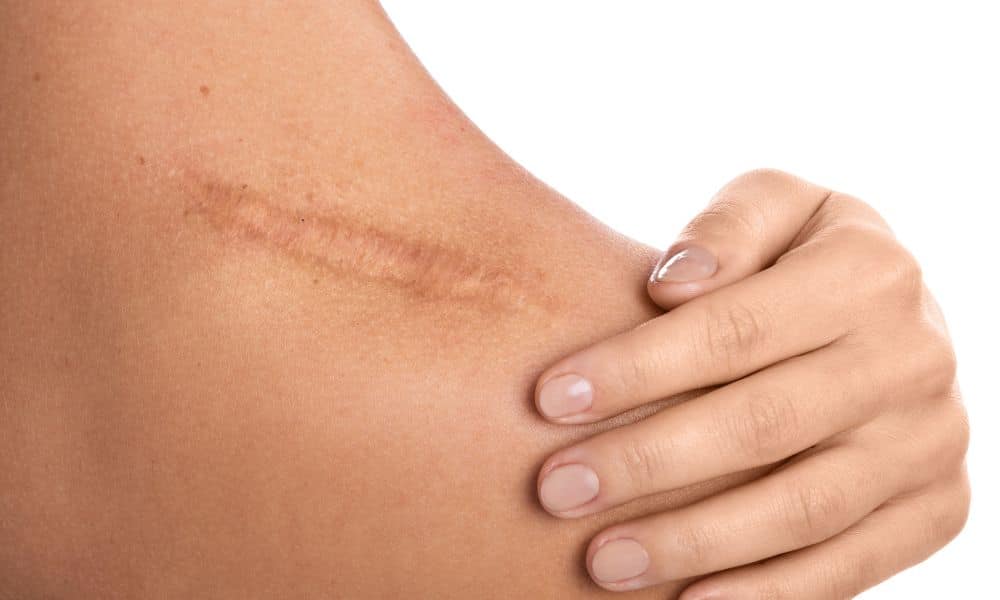 5 Ways to Eliminate a Scar After Surgery